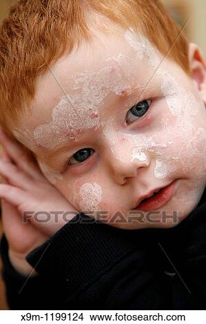 Chicken pox Stock Photo Images. 253 Chicken pox royalty ...