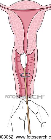 pap smear test