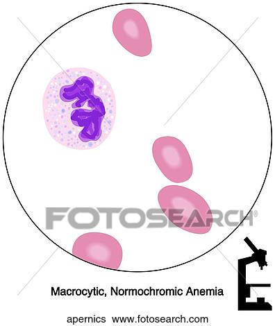 Stock Illustration of Pernicious Anemia apernics - Search Clip Art