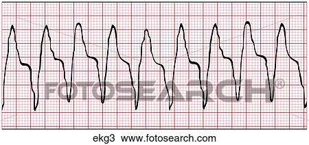 Drawing Of Ekg-ventricular Tachycardia Ekg3 - Search Clipart 