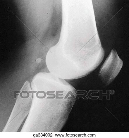 Clip Art Of Bony Anomalies. B. Fabella, Lateral View. A Sesamoid Bone ...