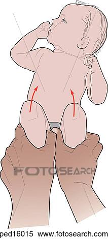 图解或向量图 - ortolani, 测试, 是, 执行, 上, 婴儿, 为了检查, 为