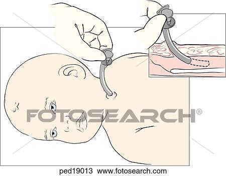 手绘图 - , tracheostomy, cannula, 入, 航线, 在中, 婴儿, 通过