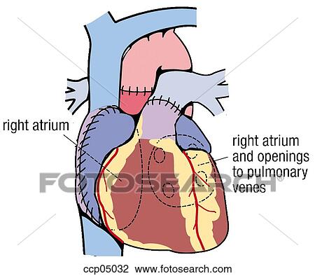 Clip Art of Heart transplantation ccp05032 - Search Clipart ...