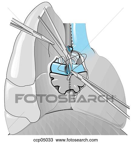 Drawing of Heart transplantation ccp05033 - Search Clipart ...