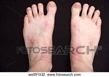 Cura di psoriasi asd frazione 2 3 risposte