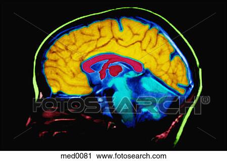 免版税(RF)类图片 - mri脑子扫描 med0081 - 搜