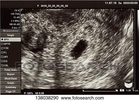 Fetal Ultrasound Scan View Large Photo Image Stock Image - Fetal Ultrasound Scan. Fotosearch