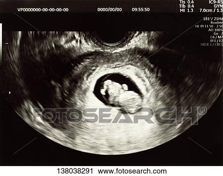 Fetal Ultrasound Scan View Large Photo Image Stock Image - Fetal Ultrasound Scan. Fotosearch