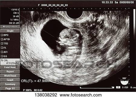 Stock Image - Fetal Ultrasound Scan. Fotosearch