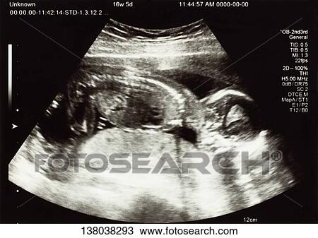 Fetal Ultrasound Scan View Large Photo Image Stock Image - Fetal Ultrasound Scan. Fotosearch