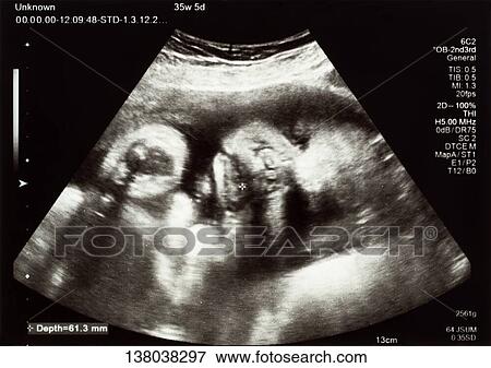 Fetal Ultrasound Scan View Large Photo Image Stock Photo - Fetal Ultrasound Scan. Fotosearch