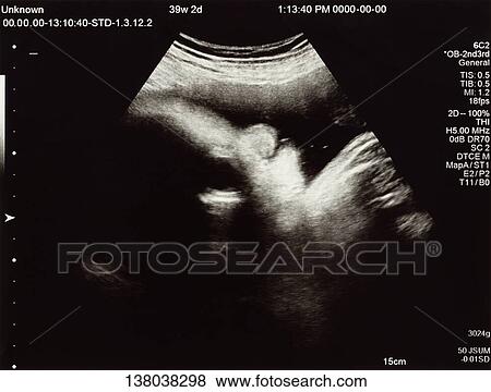 Fetal Ultrasound Scan View Large Photo Image Stock Photo - Fetal Ultrasound Scan. Fotosearch