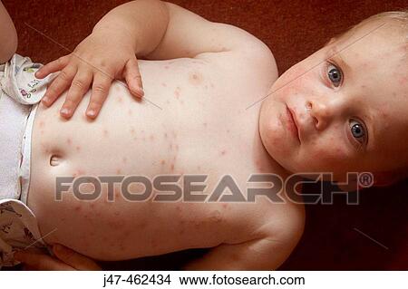 1 year old boy lying on the floor in just a nappy covered in chicken pox View Large Photo Image Picture - 1 year old boy lying on the floor in just a nappy covered in chicken pox. Fotosearch