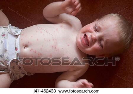 1 year old boy lying on the floor in just a nappy covered in chicken pox, crying View Large Photo Image Stock Image - 1 year old boy lying on the floor in just a nappy covered in chicken pox, crying. Fotosearch