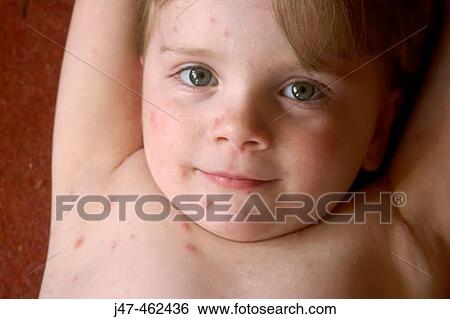 3 year old girl smiling into camera covered in chickenpox View Large Photo Image Stock Photograph - 3 year old girl smiling into camera covered in chickenpox. Fotosearch