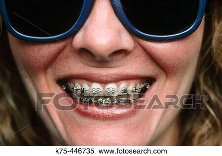 35 years old with braces. View Large Photo Image Stock Photography - 35 years old with braces.. Fotosearch