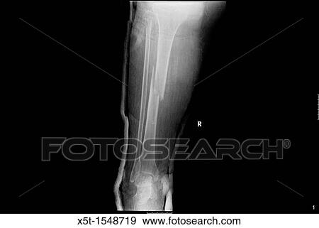 54 year old patient with a fracture of the Tibia and Fibula View Large Photo Image Stock Photo - 54 year old patient with a fracture of the Tibia and Fibula. Fotosearch