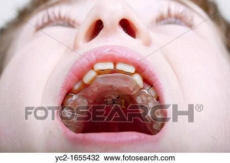 A 12 year old boy showing his dental brace for his teeth fitted in England, Britain, Uk View Large Photo Image Stock Image - A 12 year old boy showing his dental brace for his teeth fitted in England, Britain, Uk. Fotosearch