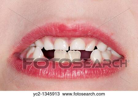 A boy of seven shows his gappy teeth close up View Large Photo Image Stock Image - A boy of seven shows his gappy teeth close up. Fotosearch