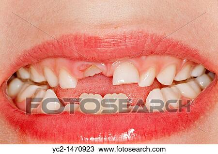 Stock Image - A close up of a seven year old childs mouth with three new teeth growing through the gums. Fotosearch