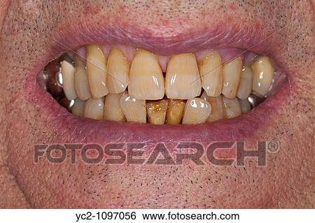 Stock Photograph - A close up of an elderly mans decaying teeth. Fotosearch