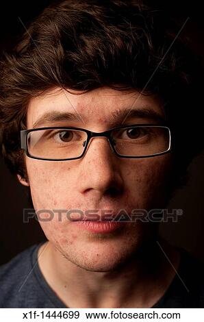 a spotty faced young man teenager youth with acne bad skin complexion wearing glasses nerd geek geeky young adult male, UK View Large Photo Image Stock Photo - a spotty faced young man teenager youth with acne bad skin complexion wearing glasses nerd geek geeky young adult male, UK. Fotosearch