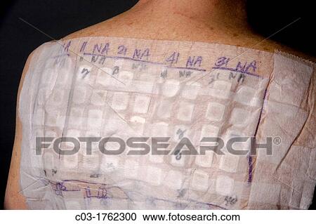 A woman patient's back is covered with the patches of an Chemotechnique Allergan Series to determine specific allergic reactions RELEASED View Large Photo Image Stock Image - A woman patient's back is covered with the patches of an Chemotechnique Allergan Series to determine specific allergic reactions RELEASED. Fotosearch