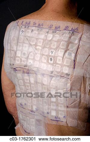 Stock Image - A woman patient's back is covered with the patches of an Chemotechnique Allergan Series to determine specific allergic reactions RELEASED. Fotosearch