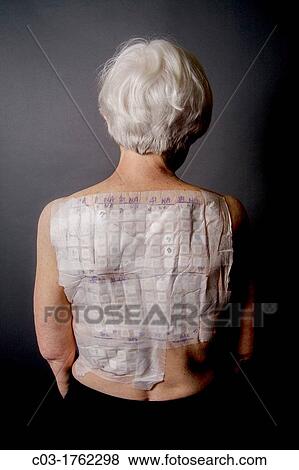 A woman patient's back is covered with the patches of an Chemotechnique Allergan Series to determine specific allergic reactions RELEASED View Large Photo Image Stock Photo - A woman patient's back is covered with the patches of an Chemotechnique Allergan Series to determine specific allergic reactions RELEASED. Fotosearch