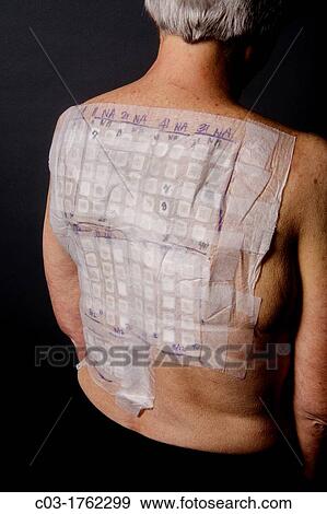 Stock Photo - A woman patient's back is covered with the patches of an Chemotechnique Allergan Series to determine specific allergic reactions RELEASED. Fotosearch