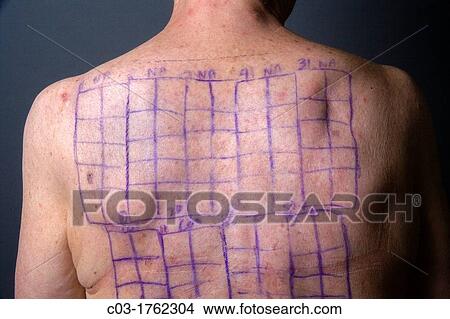 A woman patient's back is drawn with squares indicating locations for the patches of a Chemotechnique Allergan Series to determine specific allergic reactions RELEASED View Large Photo Image Picture - A woman patient's back is drawn with squares indicating locations for the patches of a Chemotechnique Allergan Series to determine specific allergic reactions RELEASED. Fotosearch