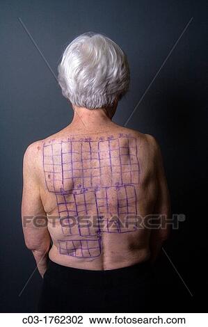 Stock Image - A woman patient's back is drawn with squares indicating locations for the patches of a Chemotechnique Allergan Series to determine specific allergic reactions RELEASED. Fotosearch