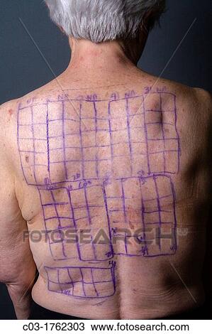 Stock Image - A woman patient's back is drawn with squares indicating locations for the patches of a Chemotechnique Allergan Series to determine specific allergic reactions RELEASED. Fotosearch
