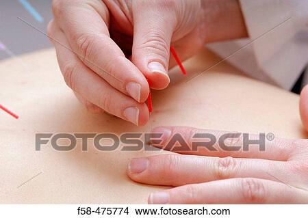 Acupuncture View Large Photo Image Picture - Acupuncture. Fotosearch
