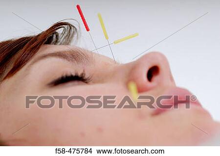 Acupuncture View Large Photo Image Picture - Acupuncture. Fotosearch