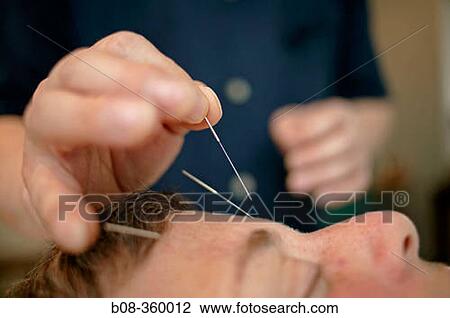 Acupuncture View Large Photo Image Stock Image - Acupuncture. Fotosearch