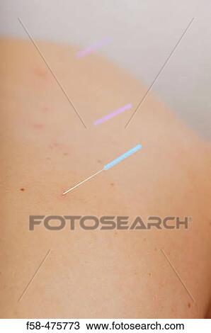 Acupuncture View Large Photo Image Stock Image - Acupuncture. Fotosearch