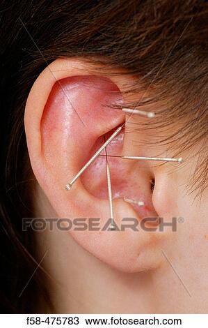 Acupuncture View Large Photo Image Stock Image - Acupuncture. Fotosearch