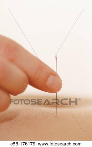 Acupuncture View Large Photo Image Stock Photo - Acupuncture. Fotosearch
