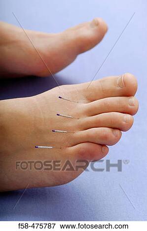 Acupuncture View Large Photo Image Stock Photo - Acupuncture. Fotosearch