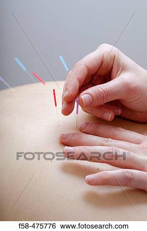 Acupuncture View Large Photo Image Stock Photograph - Acupuncture. Fotosearch