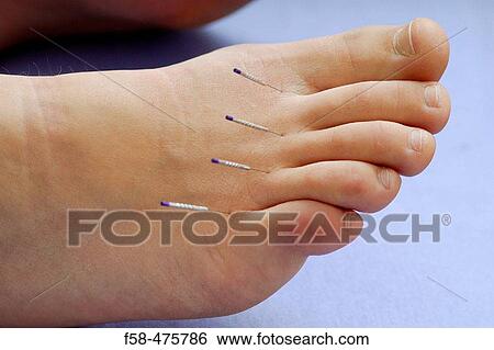 Acupuncture View Large Photo Image Stock Photograph - Acupuncture. Fotosearch