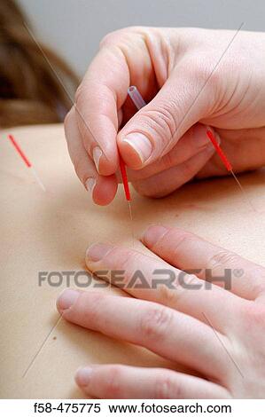Acupuncture View Large Photo Image Stock Photography - Acupuncture. Fotosearch