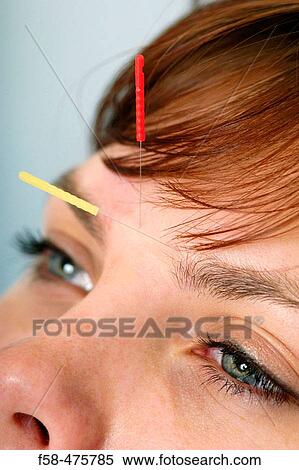 Acupuncture View Large Photo Image Stock Photography - Acupuncture. Fotosearch