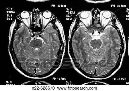 Axial plane. Magnetic Resonance of the brain. View Large Photo Image Stock Image - Axial plane. Magnetic Resonance of the brain.. Fotosearch
