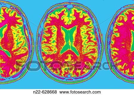 Axial plane. Magnetic Resonance of the brain. View Large Photo Image Stock Photo - Axial plane. Magnetic Resonance of the brain.. Fotosearch