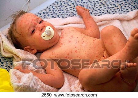 Baby affected by chicken pox View Large Photo Image Stock Image - Baby affected by chicken pox. Fotosearch