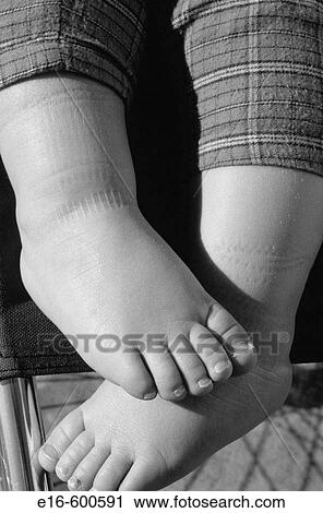Stock Image - Baby's legs. Fotosearch