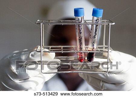 Stock Photo - Blood samples infected with AIDS in a hospital of Mozambique. Fotosearch